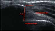 This image shows an ultrasound image in which the acromiohumeral distance (AHD) is the measurement from the most inferior aspect of the acromion to the humeral head.  This measurement spans the subacromial space and within this space lays the supraspinatus tendon.